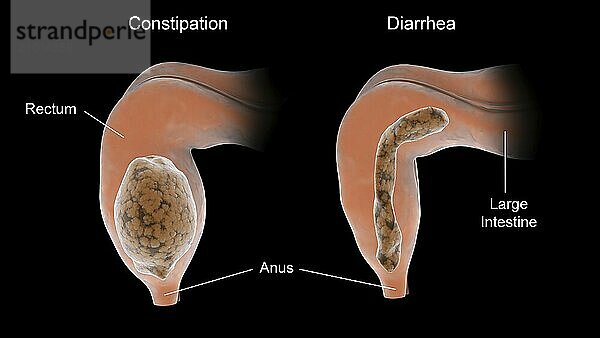 Comparison diagram of constipation vs. diarrhea in the human body