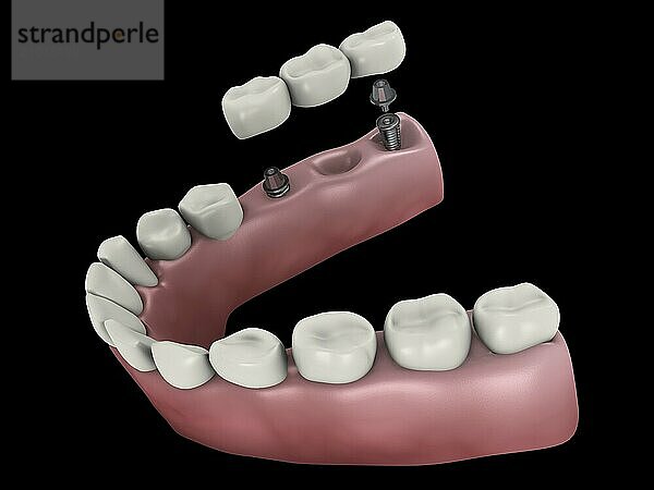 Medical illustration of a dental bridge