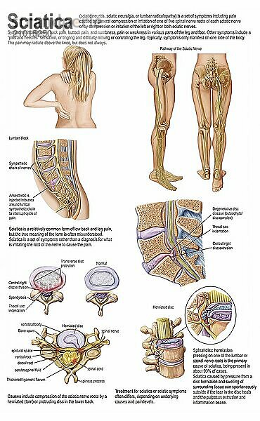 Medical chart showing the signs and symptoms of sciatica