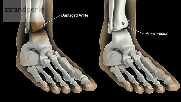 Biomedical illustration showing ankle fusion