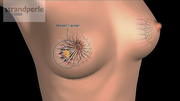 Medical illustration showing breast cancer