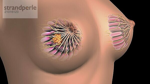 Medical illustration showing breast cancer