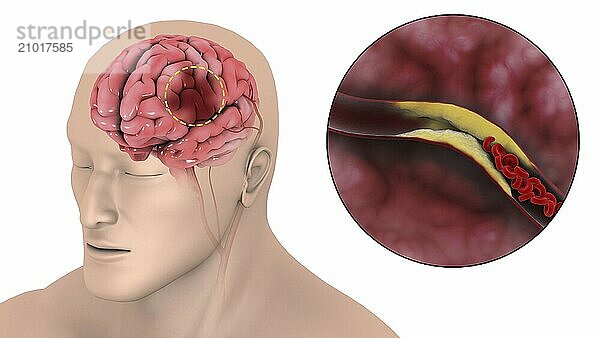 Medical illustration of an ischemic stroke  where blood supply to part of the brain is decreased