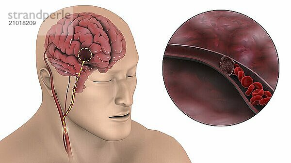 Medical illustration of an ischemic stroke  where blood supply to part of the brain is decreased