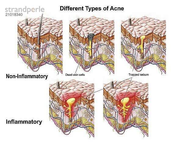 Different types of acne  non-inflammatory and inflammatory