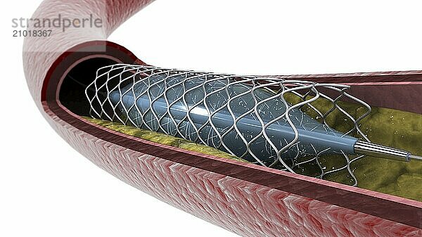 Cross-section of artery showing angioplasty and stent deployment