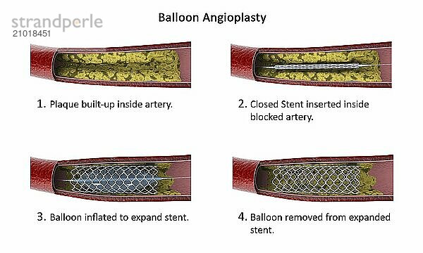 Diagram showing procedure of balloon angioplasty to widen obstructed arteries