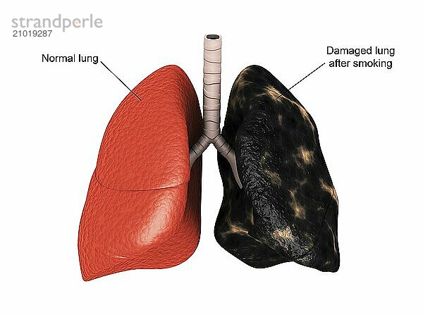 Comparison of a healthy lung vs. a smoker's lung