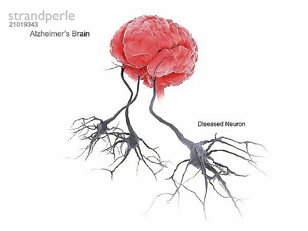 Medical illustration of a brain with alzheimer's disease  showing diseased neuron