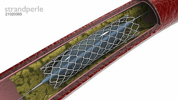 Cross-section of artery showing angioplasty and stent deployment