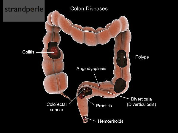 Medical illustration showing types of colon diseases