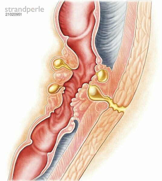 Development of fistula