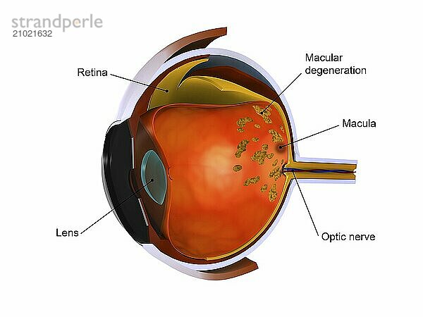 Biomedical illustration of macular degeneration