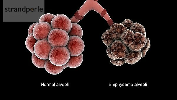 Medical comparison of healthy alveoli and an unhealthy emphysema alveoli