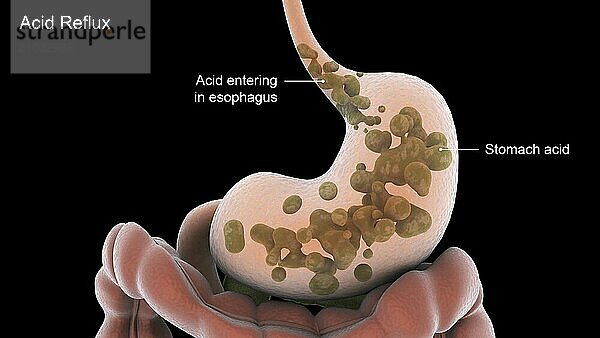 Biomedical illustration of acid reflux in the stomach