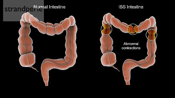 Medical illustration showing normal vs. abnormal contractions associated with irritable bowel syndrome in the human intestines