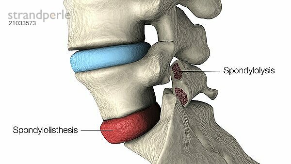 Medical illustration highlighting spondylolisthesis and spondylolysis in the human vertebra