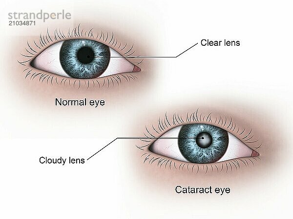 Medical illustration of a cataract in the human eye  compared to a normal eye