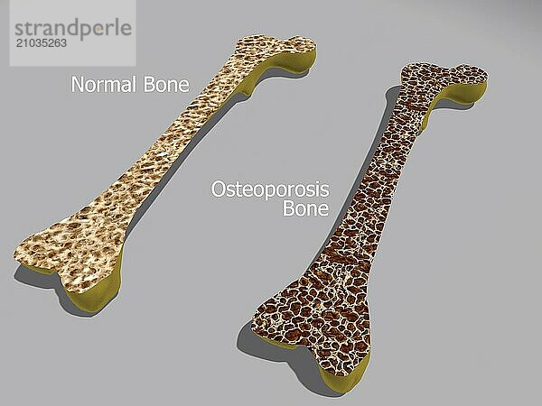 Comparison of a healthy bone and a bone with osteoporosis. Osteoporosis leads to a decrease in bone mass and density  causing bones to become weak and brittle