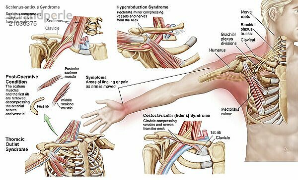 Medical illustration detailing thoracic outlet syndrome