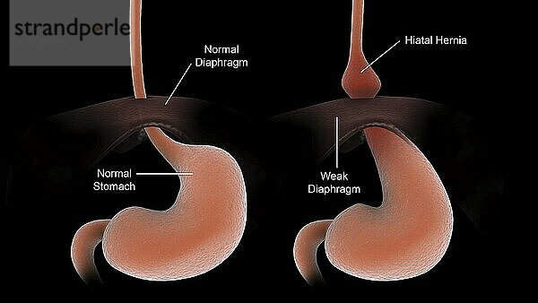 Medical comparison of a healthy human stomach  and an unhealthy human stomach with hiatal hernia