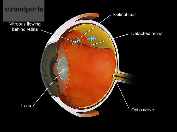 Medical illustration of a detached retina