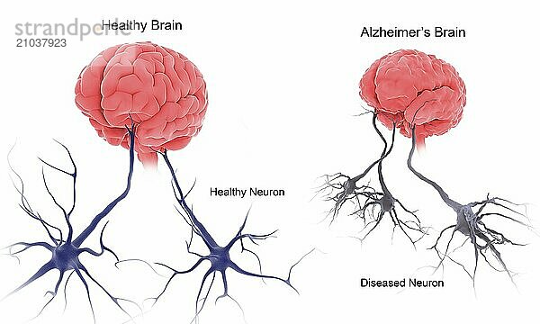 Medical comparison of a healthy brain and a brain with alzheimer's