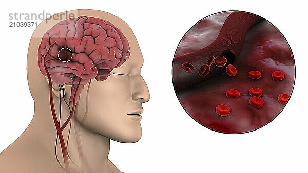 Medical illustration of an hemorrhagic stroke in the brain