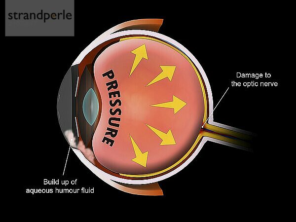 Medical illustration showing increased pressure in the eyeball  leading to glaucoma