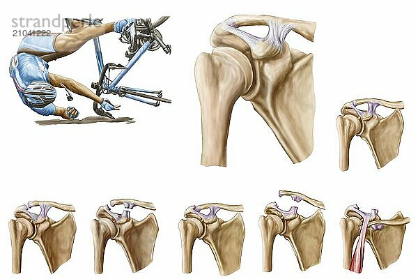 Anatomy of acromioclavicular joint rupture and displacement