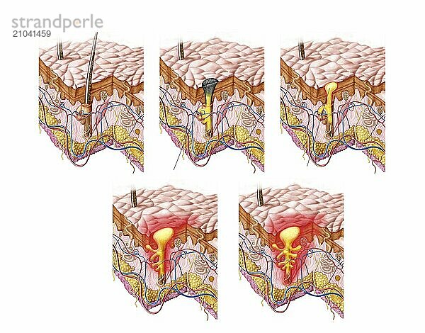 Different types of acne  non-inflammatory and inflammatory