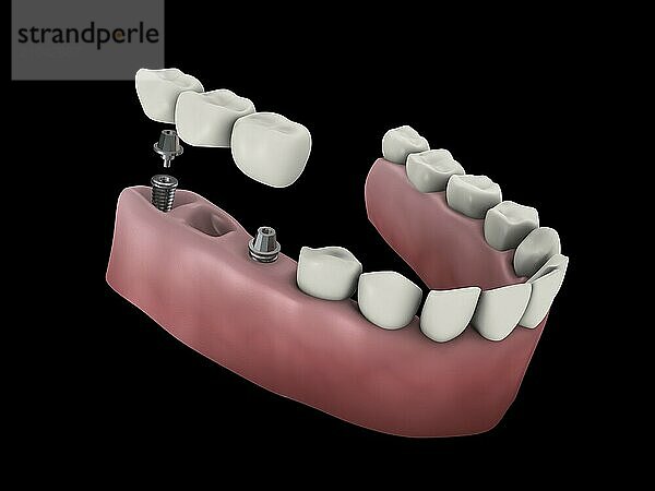 Medical illustration of a dental bridge