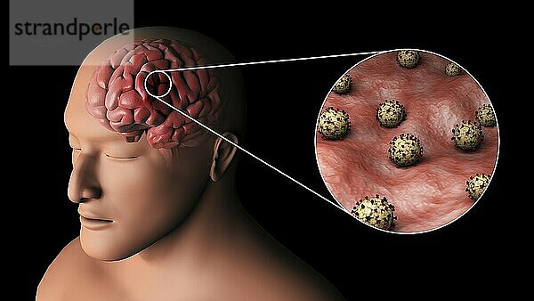 Biomedical illustration of eastern equine encephalitis inside the brain  with magnified section