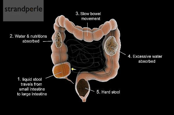 Medical diagram illustrating constipation in the human intestines