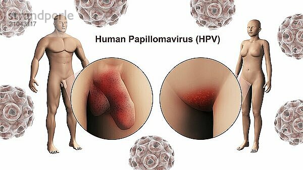 Medical illustration of the human papillomavirus infection (HPV infection) in the male and female genitals