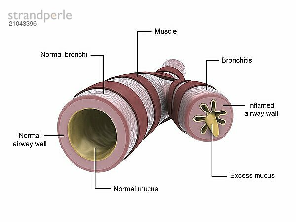 Medical illustration showing bronchitis