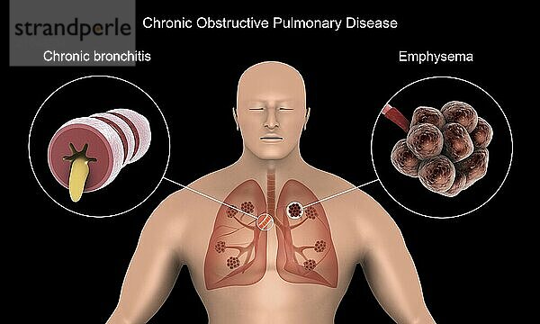 Chronic Obstructive Pulmonary Disease (COPD)