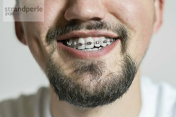 Close up of a young man with braces smiling. Macro shot of a young man with braces on a white background